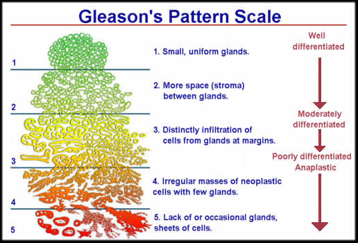 Gleason Score Chart