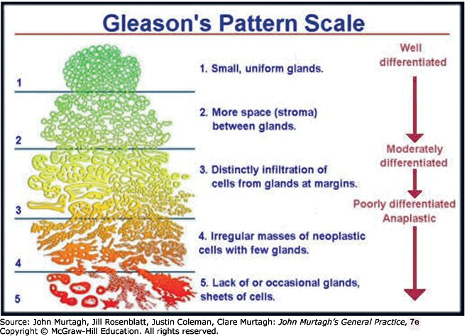 adenocarcinoma de prostata gleason 33 score 6