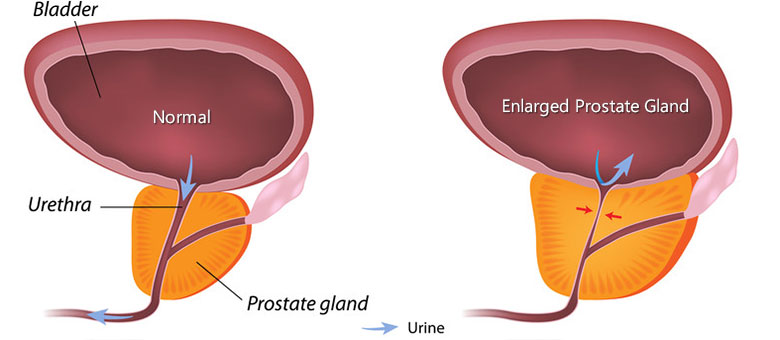 does testosterone replacement therapy cause enlarged prostate