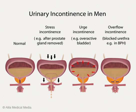 medilllarge urinaryincontmale