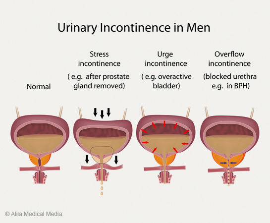 Enurreza a prostatitis miatt